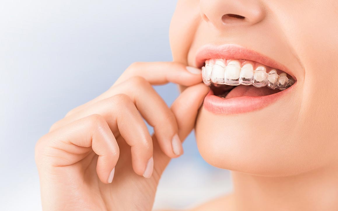 Invisalign clear aligners at Weaver Orthodontics
